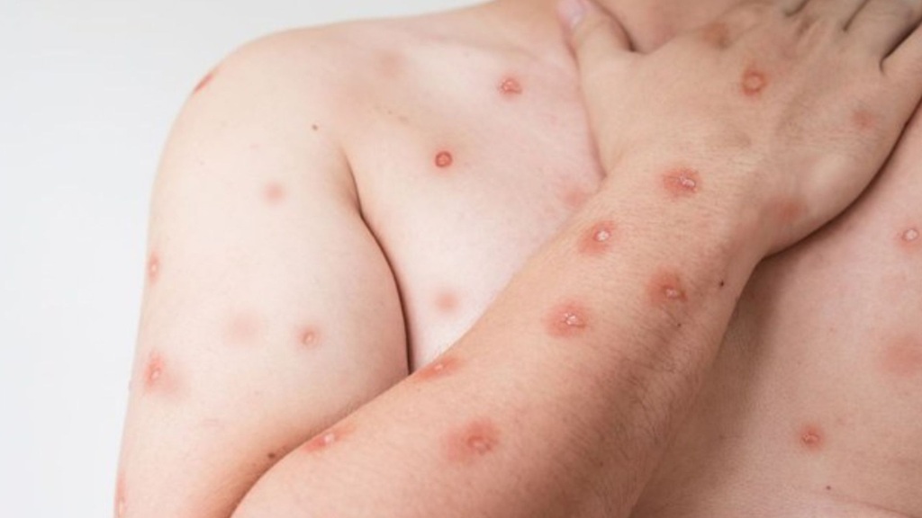 Mesmo sem casos suspeitos, Secretaria de Saúde emite informe sobre vírus MPOX